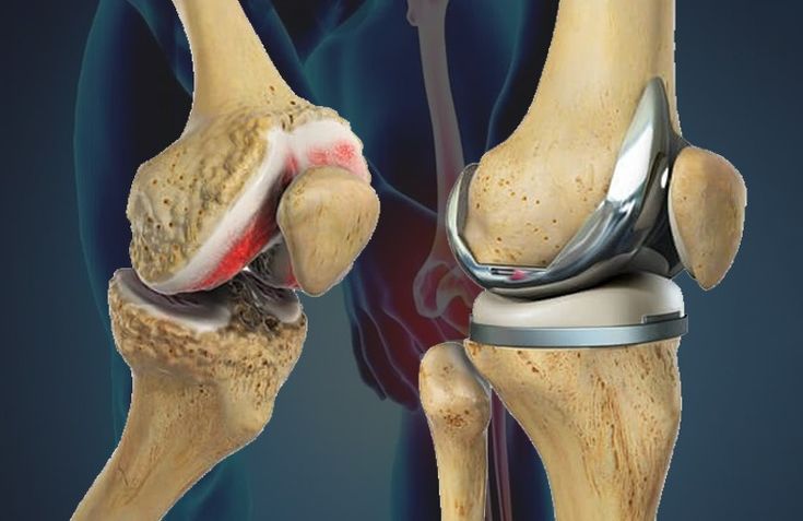 Dr. Palash Gupta - Hip Replacement Surgeon in Delhi NCR