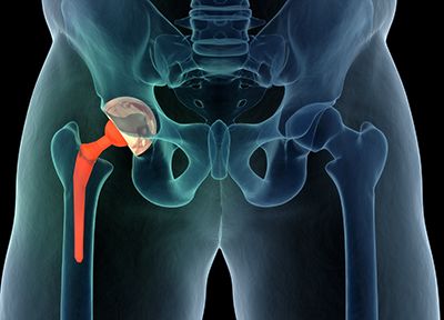 Latest Hip Replacement Treatment Options in Delhi - Dr. Palash Gupta